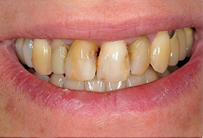 Westhampton Beach Before and After Teeth Whitening