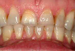 Westhampton Beach Before and After Teeth Whitening